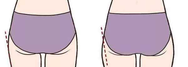 假胯寬矯正需要多久,假胯寬鍛煉幾個(gè)月能糾正過(guò)來(lái)圖2