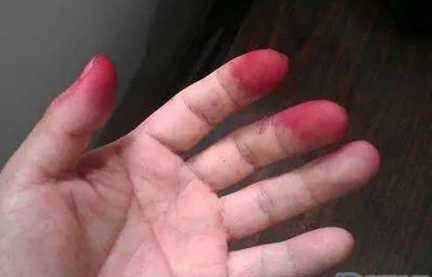 吃了桑葚手指黑色怎么洗,桑葚把手弄黑怎么辦圖3