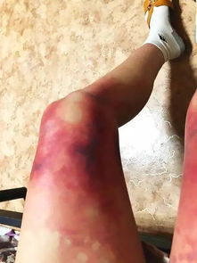 冬季防凍傷安全小知識