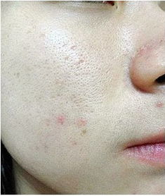 什么去痘印最好最快方法有哪些