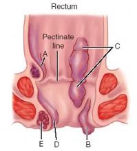 痔瘡都有哪些手術(shù)方法