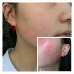 中醫(yī)去紅血絲有哪些方法有哪些