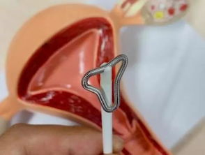 用避孕的方法有哪些方法有哪些方法