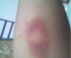 血小板減少原因有哪些如何治療方法