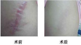 手術(shù)后治療疤痕的藥物有哪些方法