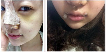 哪些方法可以使嘴巴變小