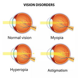 矯正近視的手術(shù)有哪些方法有哪些方法