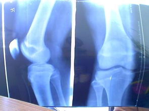 哪些方法促進(jìn)骨骼發(fā)育