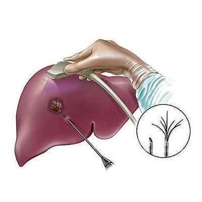 得了肝癌會(huì)有哪些癥狀怎么治療方法