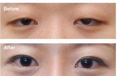 讓上眼皮不下垂的方法有哪些