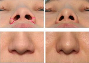 縮小鼻孔的方法有哪些方法有哪些方法