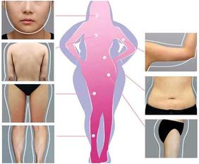 廣州吸脂方法有哪些