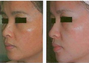 深圳去黃褐斑的方法有哪些方法