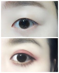 做了雙眼皮怎么恢復最快方法有哪些問題