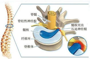 腰椎間盤突出癥狀治療有哪些方法及治