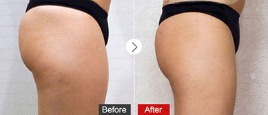 吸脂手術(shù)好方法有哪些