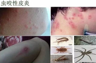 防蟲(chóng)叮咬的方法都有哪些