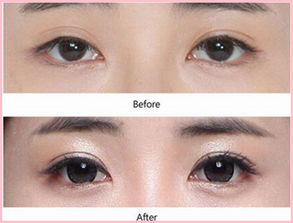 雙眼皮修復(fù)手術(shù)方法有哪些方法