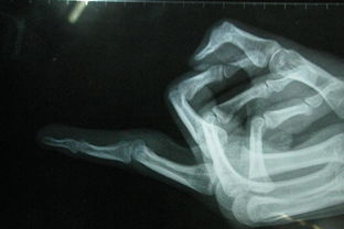 手關(guān)節(jié)軟組織挫傷怎么處理？(軟組織挫傷多久能好？)