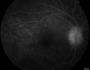 視神經(jīng),乳頭,注意事項(xiàng)