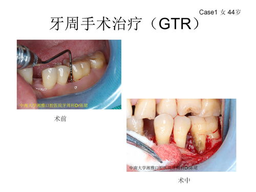 牙周翻瓣術(shù)的注意事項,牙周翻瓣術(shù)術(shù)后注意事項,牙周翻瓣術(shù)