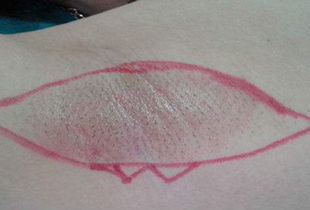 腳趾手術拆線后注意事項