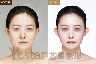 剛打了瘦臉針要注意什么,打瘦臉針后需要注意什么,打完瘦臉針注意事項(xiàng)