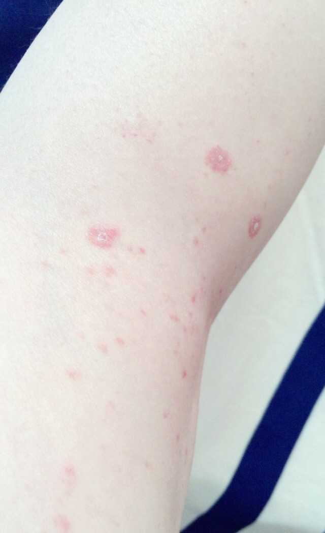 得了玫瑰糠疹注意什么,玫瑰糠疹注意事項,玫瑰種植方法和注意事項