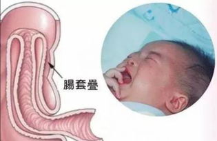 腸梗阻灌腸注意事項(xiàng)