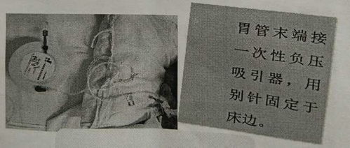 皮下引流管的注意事項(xiàng)