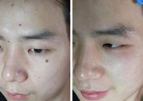 點(diǎn)痣有什么注意事項(xiàng)