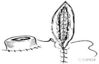 回腸造瘺術(shù)后注意事項(xiàng)