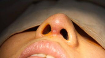 做了線雕鼻注意事項(xiàng)