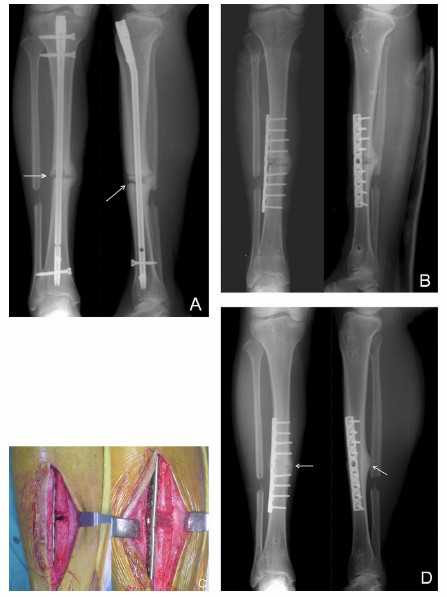 脛骨骨折手術后注意事項,脛骨截骨術后注意事項,脛骨取鋼板后注意事項