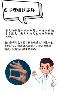 皮下埋植術(shù)后注意事項,皮下埋植避孕注意事項,皮下埋植避孕術(shù)后注意事項