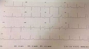 測量動態(tài)心電圖注意事項,做心電圖注意事項,心電圖的使用方法及注意事項