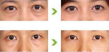 做眼袋手術(shù)注意事項(xiàng)