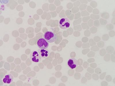 懸浮紅細(xì)胞輸注的注意事項(xiàng)