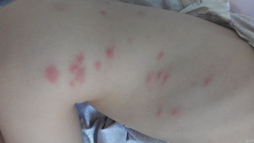 螨蟲皮炎注意事項(xiàng)