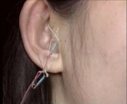 電針炙后注意事項(xiàng)