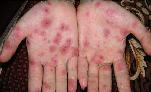 紅霉素,梅毒,注意事項,治療