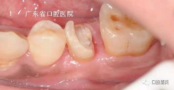 牙冠延長(zhǎng)手術(shù)后注意什么,牙冠延長(zhǎng)手術(shù)后多久可以裝牙套,牙冠延長(zhǎng)手術(shù)疼嗎