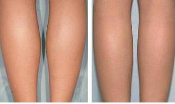 注意事項,抽脂,大腿內(nèi)側(cè)