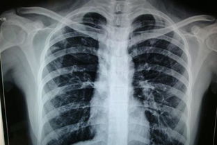 x光胸片注意事項,拍x光胸片注意事項,拍胸片注意事項