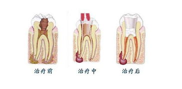 做根管治療后需要注意什么,做完牙齒根管治療后需要注意什么,做完根管治療后注意事項(xiàng)