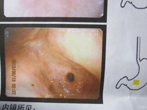 胃炎,術(shù)后,注意事項(xiàng)