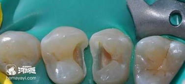 寶寶補牙后注意事項