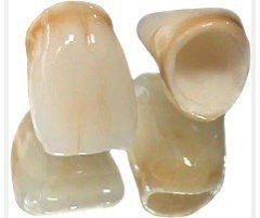 全瓷冠修復(fù)的注意事項