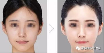 注射,注意事項,自體,美容