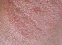 體癬應(yīng)注意事項